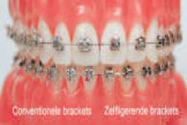 Brackets